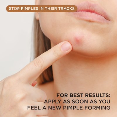 Everyday & Stubborn Care Pimple Patches (272 Count)
